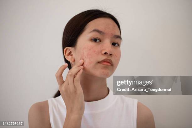 woman with acne - acne stock pictures, royalty-free photos & images