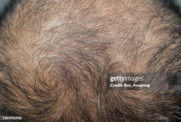 full frame shot of dandruff problem on men's head. dandruff is a skin condition that causes itchy. - dandruff stock-fotos und bilder