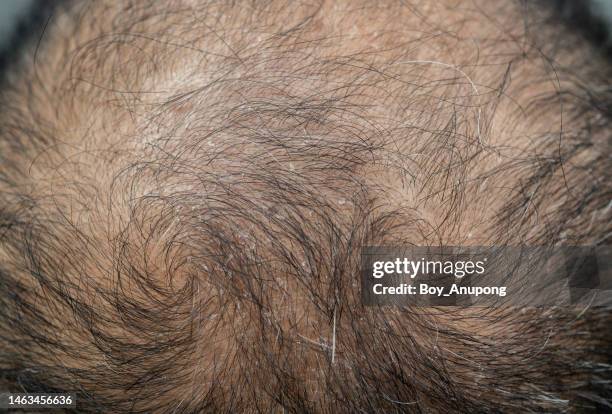 full frame shot of dandruff problem on men's head. dandruff is a skin condition that causes itchy. - caspa - fotografias e filmes do acervo