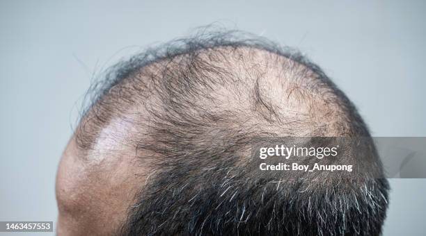 close up of asian man having baldness. hair loss and gray hair is the sign of aging on men. - ugly bald man stock pictures, royalty-free photos & images