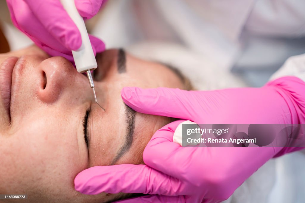 Doctora realizando el rejuvenecimiento cosmético de la piel del paciente. Blefaroplastia no quirúrgica con plasma.