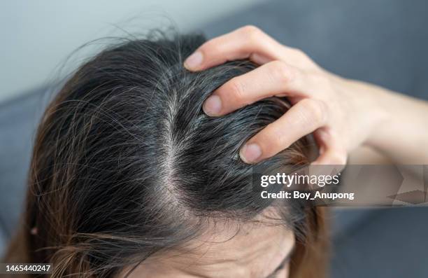 close up of dandruff problem on woman head. dandruff is a skin condition that causes itchy. - cuero cabelludo fotografías e imágenes de stock