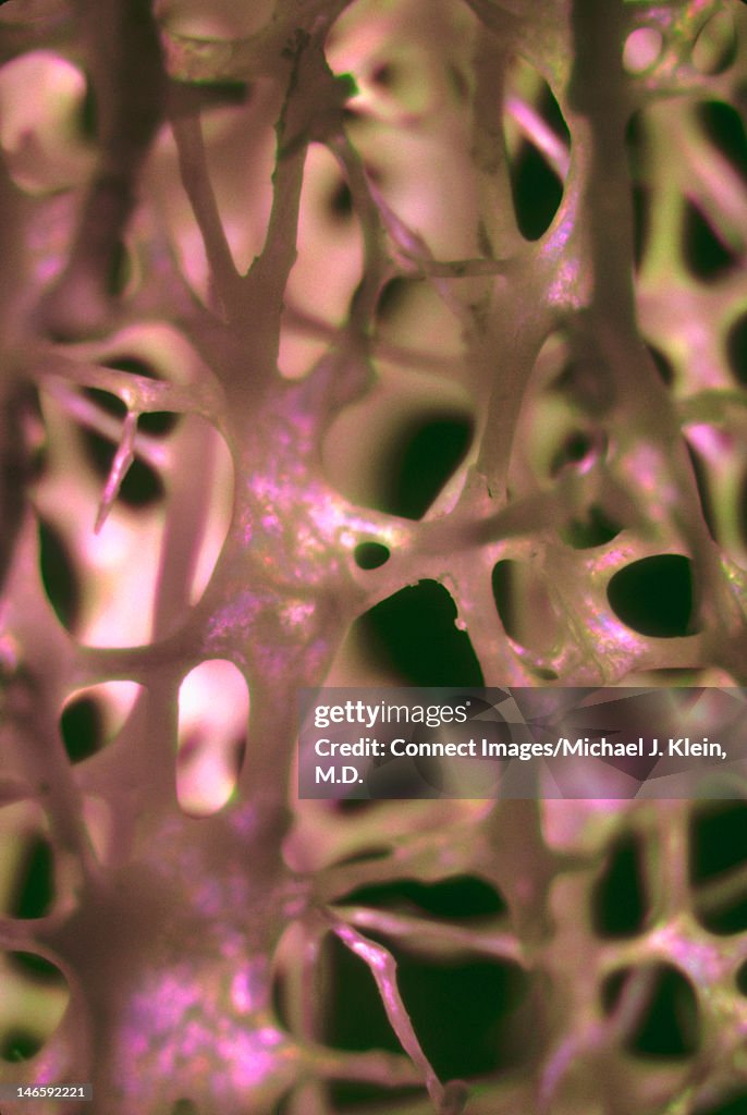 Macerated bone with osteoporosis