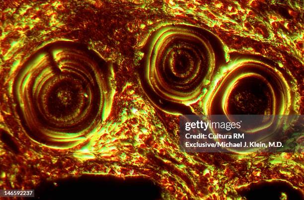 benign calcifications in breast ducts - benign tumor stockfoto's en -beelden