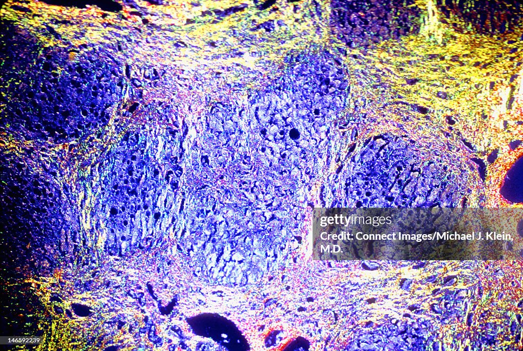 Cirrhosis of liver cells