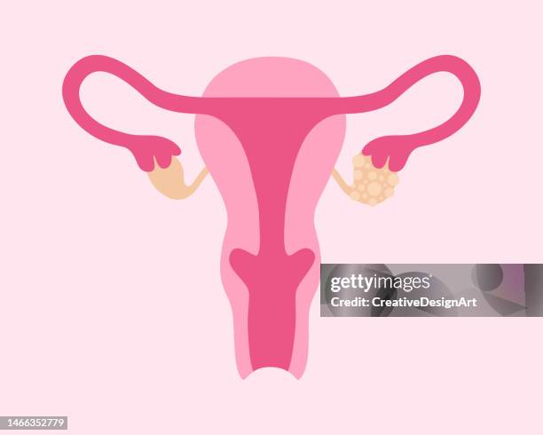 ilustraciones, imágenes clip art, dibujos animados e iconos de stock de síndrome de ovario poliquístico. sistema reproductor femenino con quistes ováricos - cervix