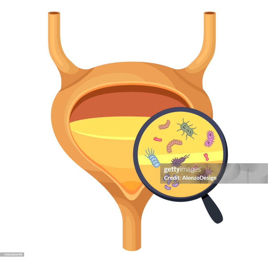 Bladder with urine. Infection and inflammation of urine. Virus and bacteria. Bacterial infection.