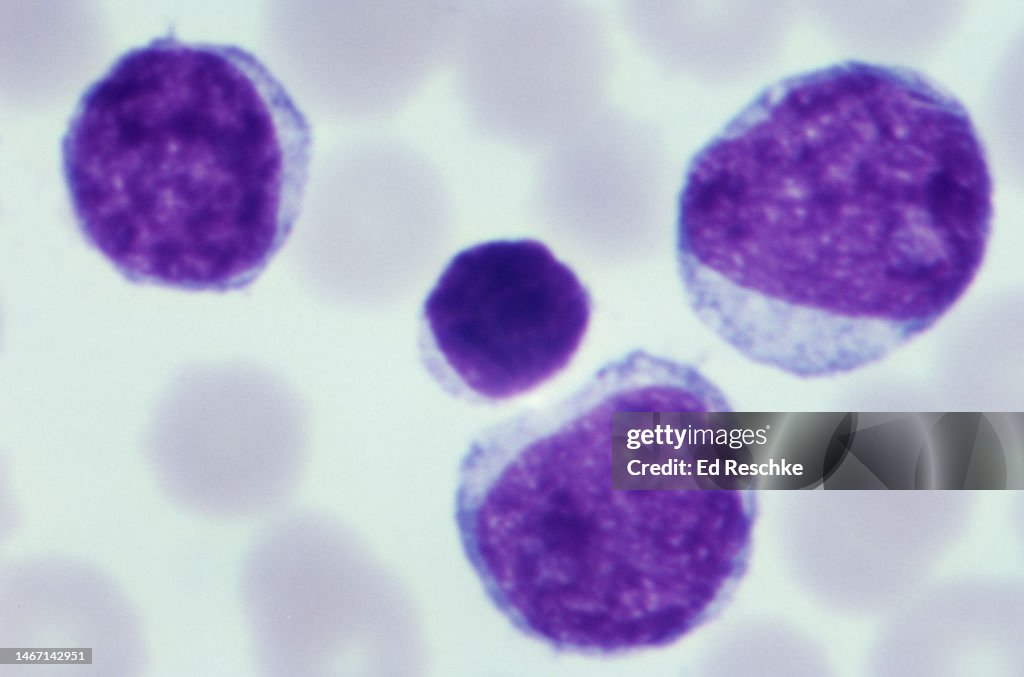 Lymphlo Lymphatic Leukemia Acuteshows 3 Lymphoblasts And One Lymphocyte 640x ...