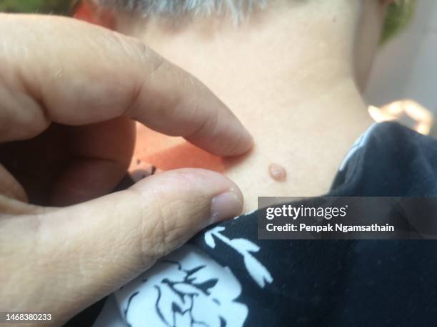 thumb and index finger holding wart on nape of the neck - warts fotografías e imágenes de stock