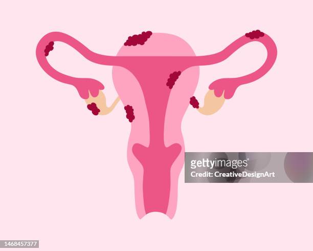endometriose-krankheit. gebärmutter mit gewebewachstum - endometriosis stock-grafiken, -clipart, -cartoons und -symbole