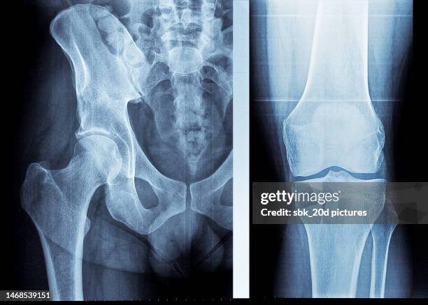 pelvis x-ray 11 - hip body part stock pictures, royalty-free photos & images