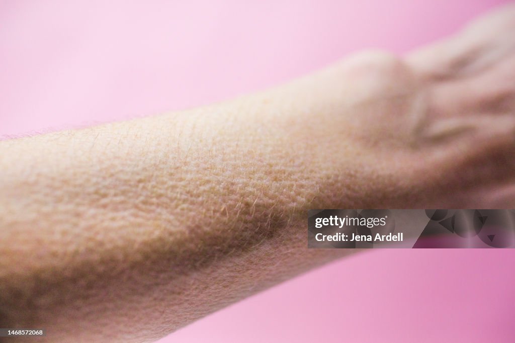 Goosebumps, Goose bumps On Arm Closeup