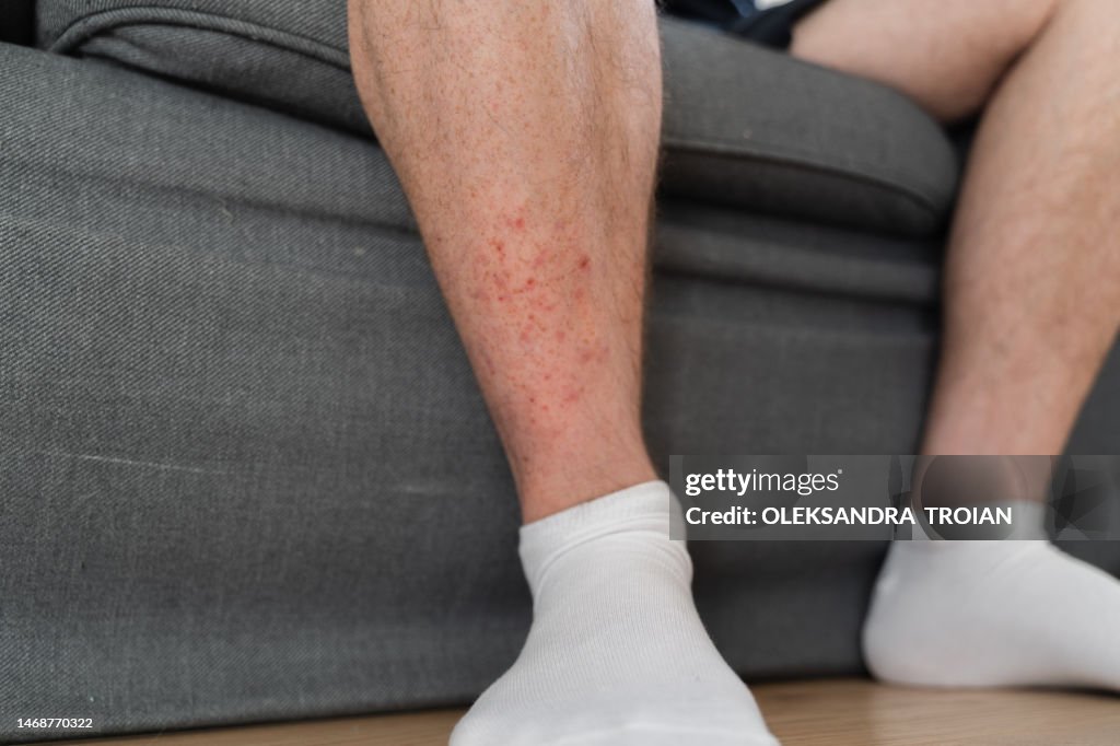 Man Leg With Dermatology Problem Red Rash On Skin High-Res Stock Photo ...