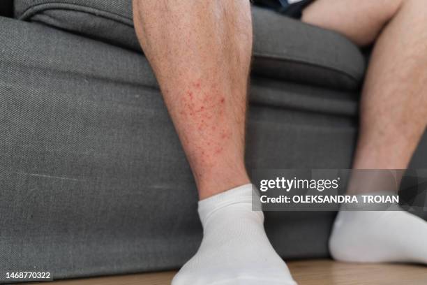 man leg with dermatology problem, red rash on skin - insect bites images - fotografias e filmes do acervo