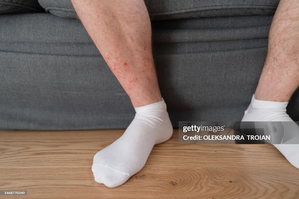 Man Leg With Dermatology Problem Red Rash On Skin High-Res Stock Photo ...