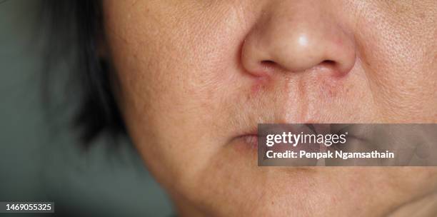 dry skin with red spot near nose - skin rash stock pictures, royalty-free photos & images