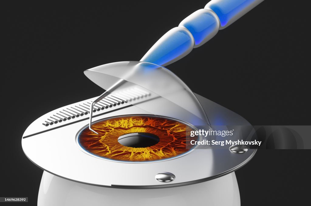 Surgical operation to remove the anterior chamber of the human eye with surgical instruments.