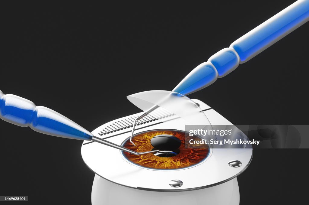 Surgical operation to remove the anterior chamber of the human eye with surgical instruments.