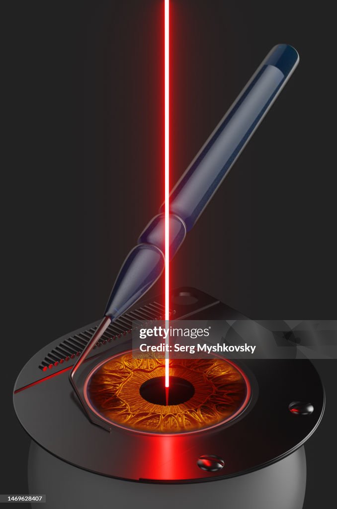 Surgery to remove the lens of a human eye with a cataract using a laser.