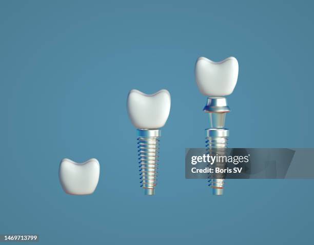 dental implant - implante dentário imagens e fotografias de stock