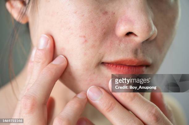 cropped shot of asian woman having wrinkled and acne scar occur on her face. - dermatologia fotografías e imágenes de stock