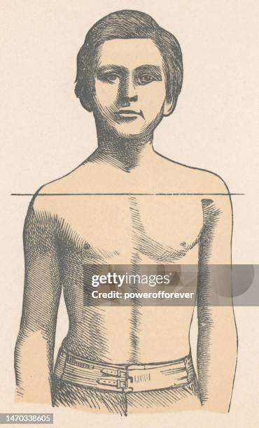 medical illustration of young adult man with poor posture - 19th century - uneven stock illustrations