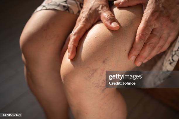 treating broken capillaries - deep vein thrombosis stock pictures, royalty-free photos & images