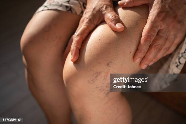 treating broken capillaries - human limb stock pictures, royalty-free photos & images