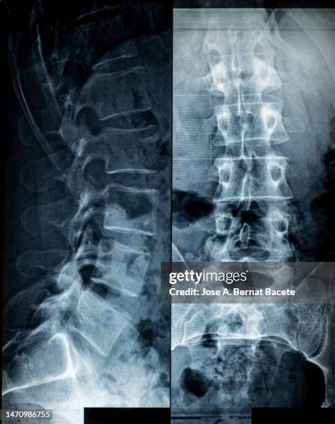 x-ray image of human lumbar vertebrae and spine with osteoporosis. - osteoporosis in lumbar spine stock pictures, royalty-free photos & images