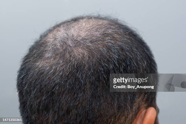 close up of asian men's head with bald spot and few gray hair. hair loss and gray hair is the sign of aging on men. - cheveux court homme photos et images de collection