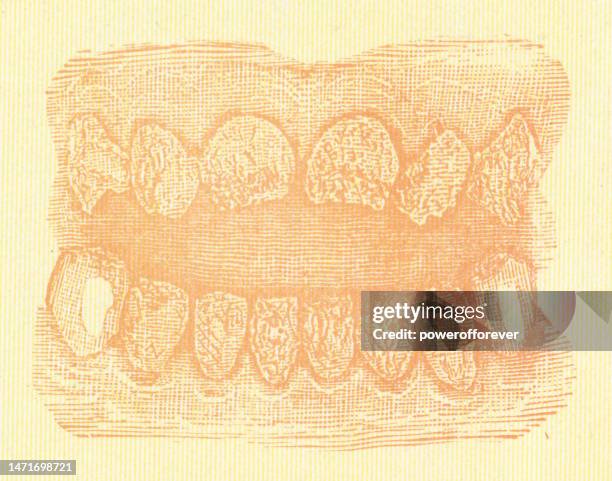 ilustrações de stock, clip art, desenhos animados e ícones de medical illustration of the effects of syphilis and prescribed mercury poisoning has on human teeth - 19th century - treponema pallidum