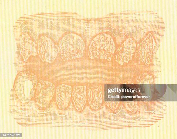 medical illustration of the effects of syphilis and prescribed mercury poisoning has on human teeth - 19th century - infectious disease contact diagram stock illustrations