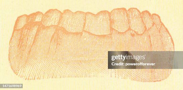 medical illustration of the effects of syphilis and prescribed mercury poisoning has on human teeth - 19th century - human jaw bone stock illustrations