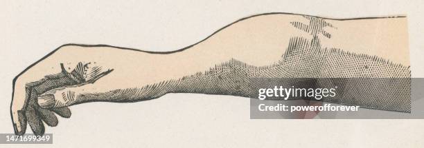 ilustrações de stock, clip art, desenhos animados e ícones de medical illustration of periostitis caused by syphilis on a human arm - 19th century - treponema pallidum