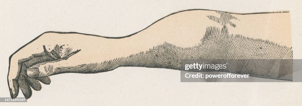 Syphilis Drawing Medical Illustration Of Periostitis Caused By Syphilis On A Human Arm ...