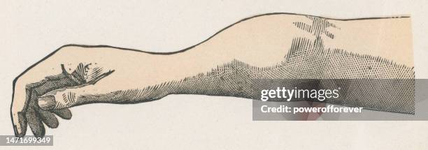 medical illustration of periostitis caused by syphilis on a human arm - 19th century - infectious disease contact diagram stock illustrations