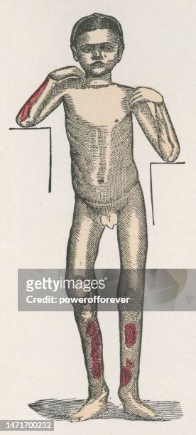 ilustraciones, imágenes clip art, dibujos animados e iconos de stock de ilustración médica de un niño adolescente con sífilis congénita - siglo 19 - sifilis