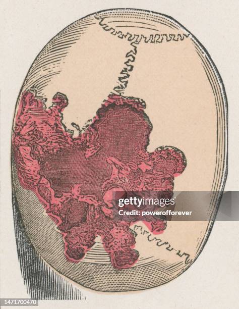 ilustrações de stock, clip art, desenhos animados e ícones de medical illustration of lesions on human skull caused by syphilis - 19th century - treponema pallidum