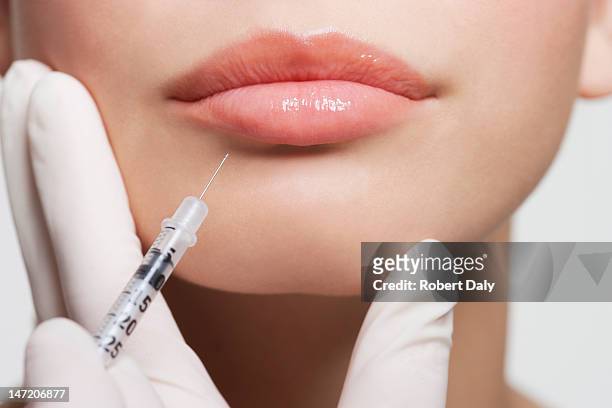 nahaufnahme von frau empfangende botox-spritze in den mund legen - botox injections stock-fotos und bilder