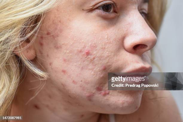 acne woman skin closeup - ugly face 個照片及圖片檔
