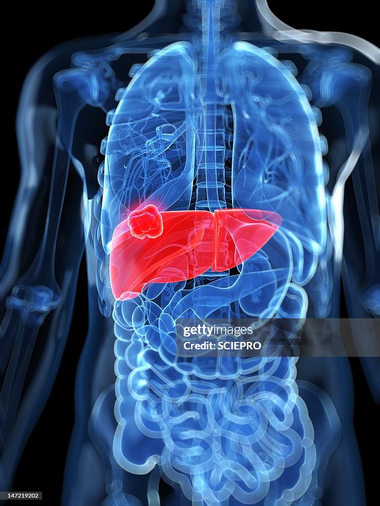Liver Cancer Artwork High-Res Vector Graphic - Getty Images
