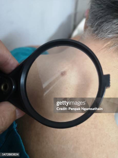 a magnifying glass looks at a mole on the nape of the neck. - where is the nape of the neck stock pictures, royalty-free photos & images