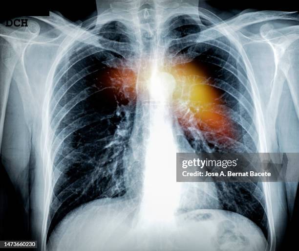 x-ray image of the chest and simulation of pain in the heart. - x ray body stock pictures, royalty-free photos & images