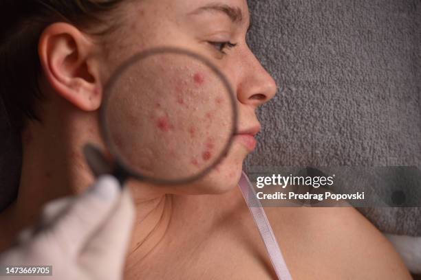 female doctor checking infected skin face of young woman - skin cancer face 個照片及圖片檔