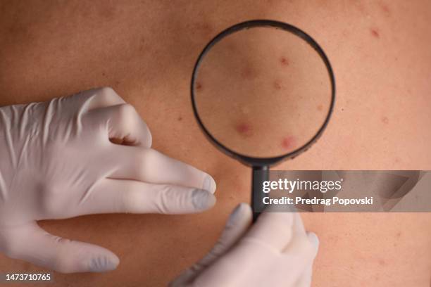 female doctor checking infected skin with acne of woman back - melanoma fotografías e imágenes de stock