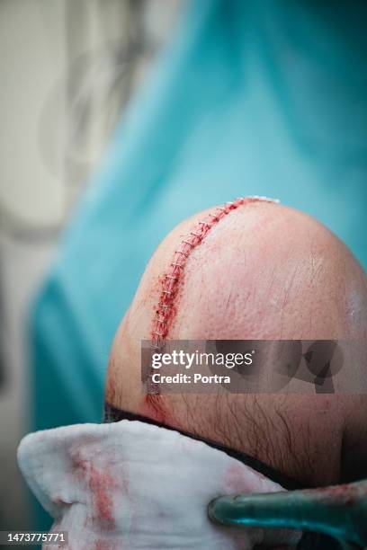 close-up of a knee replacement incision in operating room - anterior cruciate ligament stock pictures, royalty-free photos & images