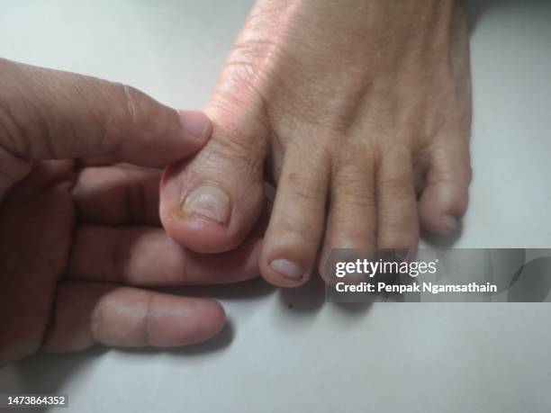 hands holding on toes, nails are fungal. - toe - fotografias e filmes do acervo