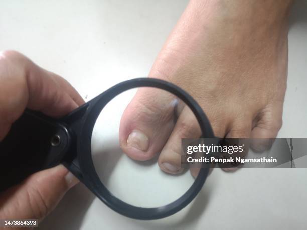 use a magnifying glass to look at the fungal toenail. - onicomicosi foto e immagini stock