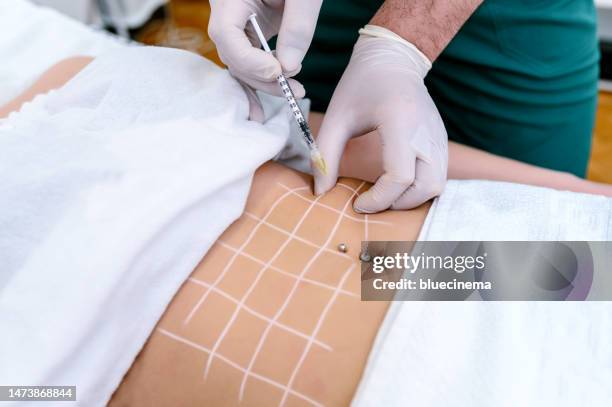 woman's having lipolysis treatment - liposuction stock pictures, royalty-free photos & images