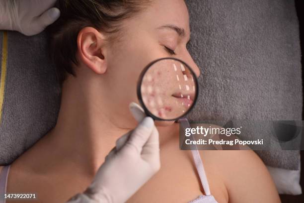 dermatologist checking infected skin on patient - pore stock pictures, royalty-free photos & images